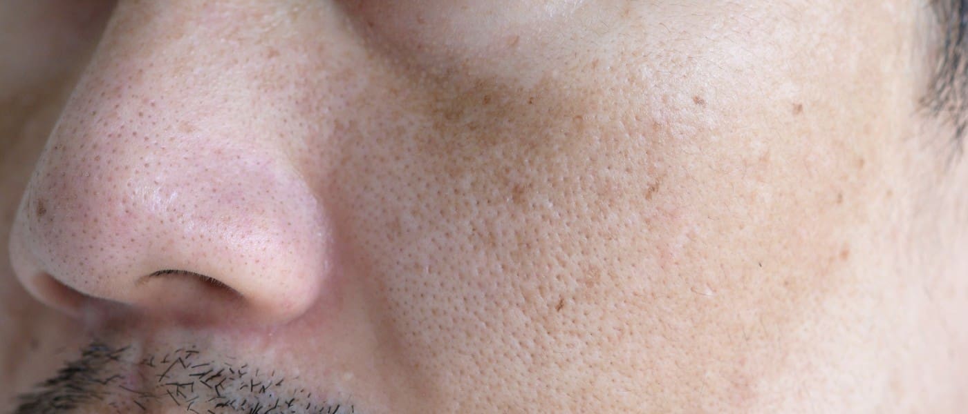 hyperpigmentation