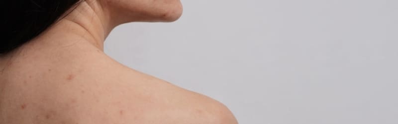 Pigmentation Treatment